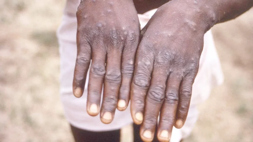 monkeypox case