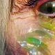 Doctor removes 23 contact lenses from eyes of Woman