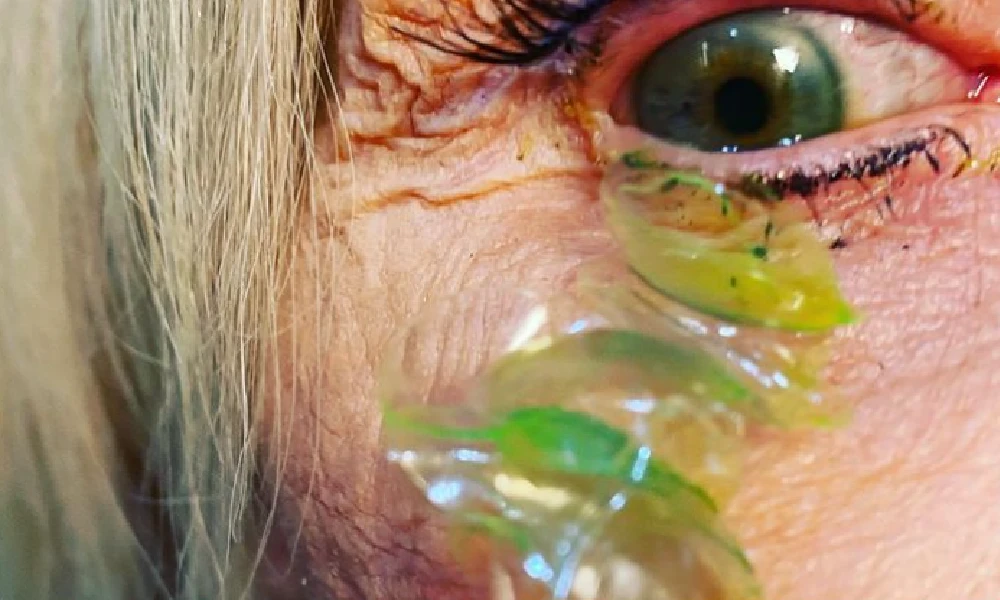 Doctor removes 23 contact lenses from eyes of Woman