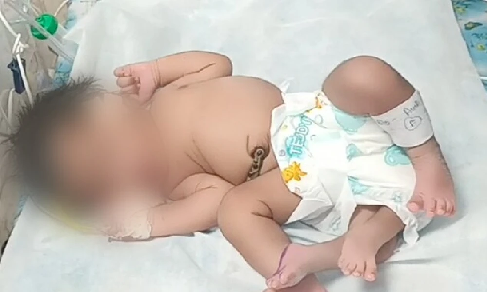 Baby girl with Four Legs Born in Madhya Pradesh