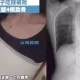 Woman fractured four ribs After Eat Spicy Food