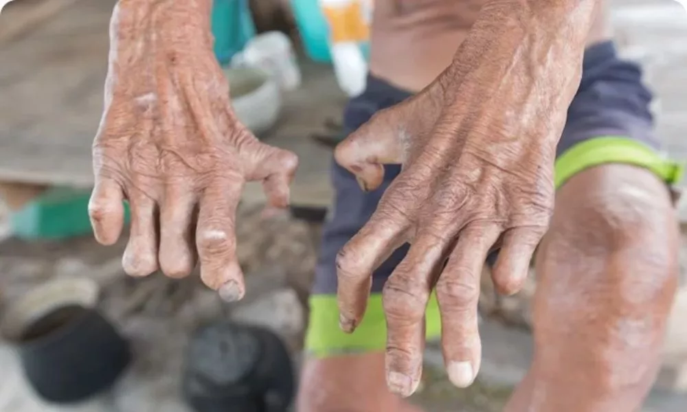 World Leprosy Day 
