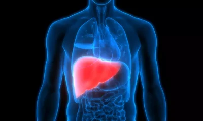 Fatty liver disease