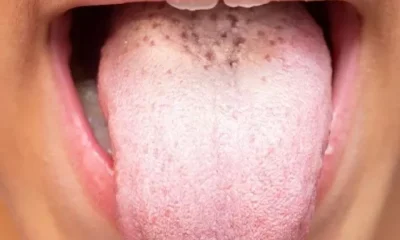 White Tongue