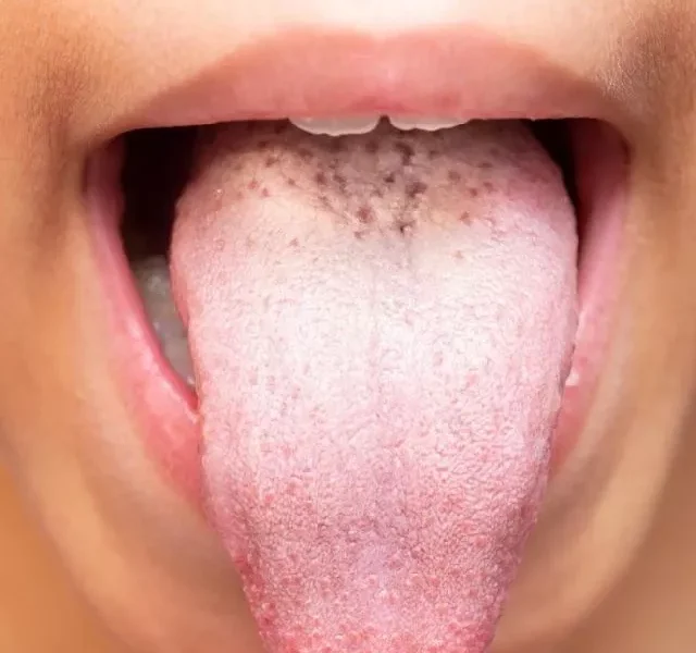 White Tongue