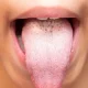 White Tongue