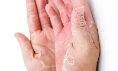 Dry Hands