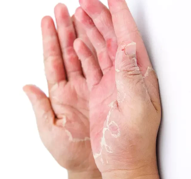 Dry Hands