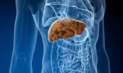 Fatty Liver Disease