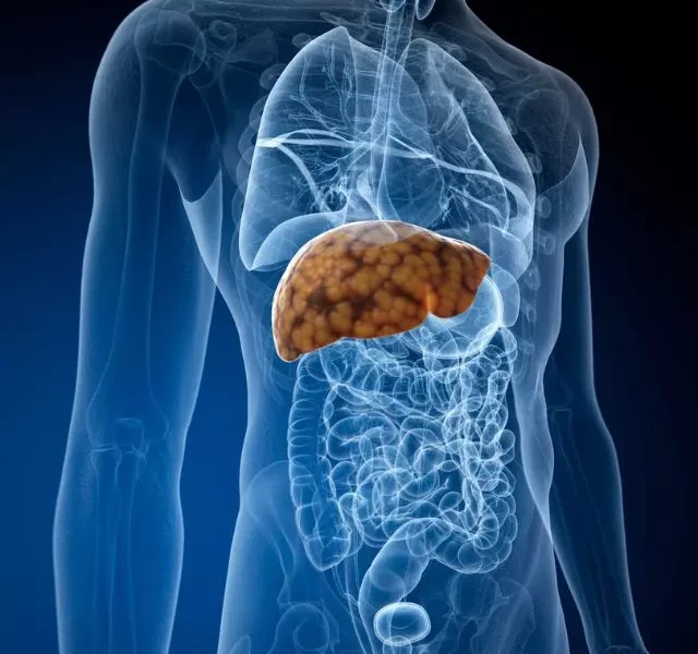 Fatty Liver Disease