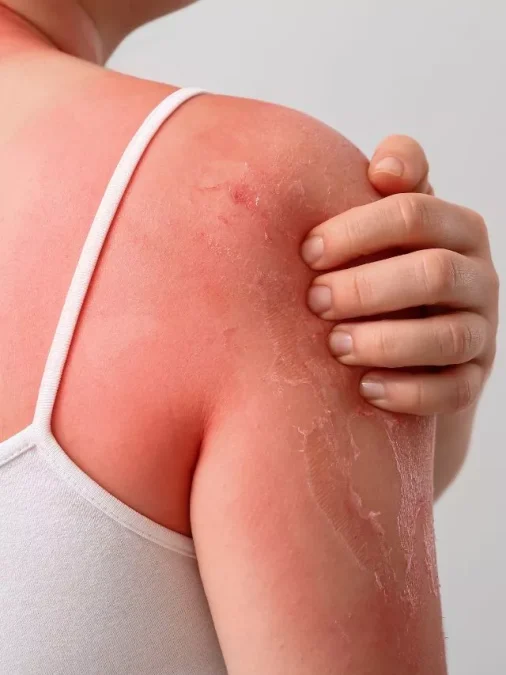 Sunburned Skin