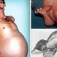 Nagpur Man suffers from Fetus in Fetu