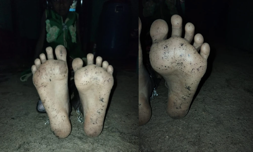dots on the legs and hands of the children of Tumakuru new fungus threat
