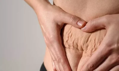 image of Home Remedies For Stretch Marks