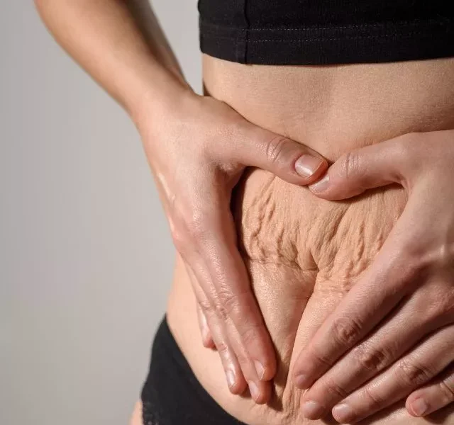 image of Home Remedies For Stretch Marks