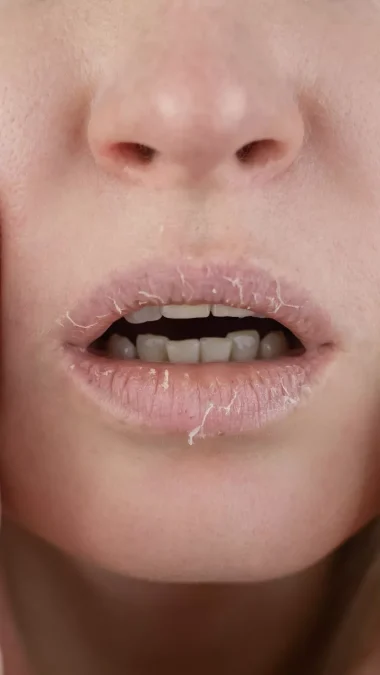Dry chapped lips Body may be dehydrated drink plenty of water Lips Healthy Tips