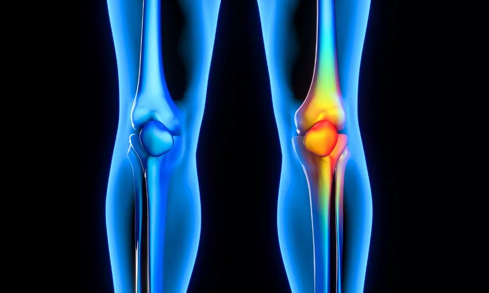 Decreased bone density