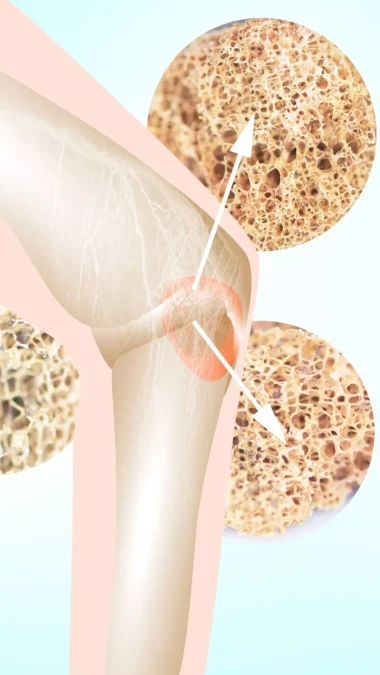 Knee bone mass Bone erosion and deterioration Pumpkin Benefits