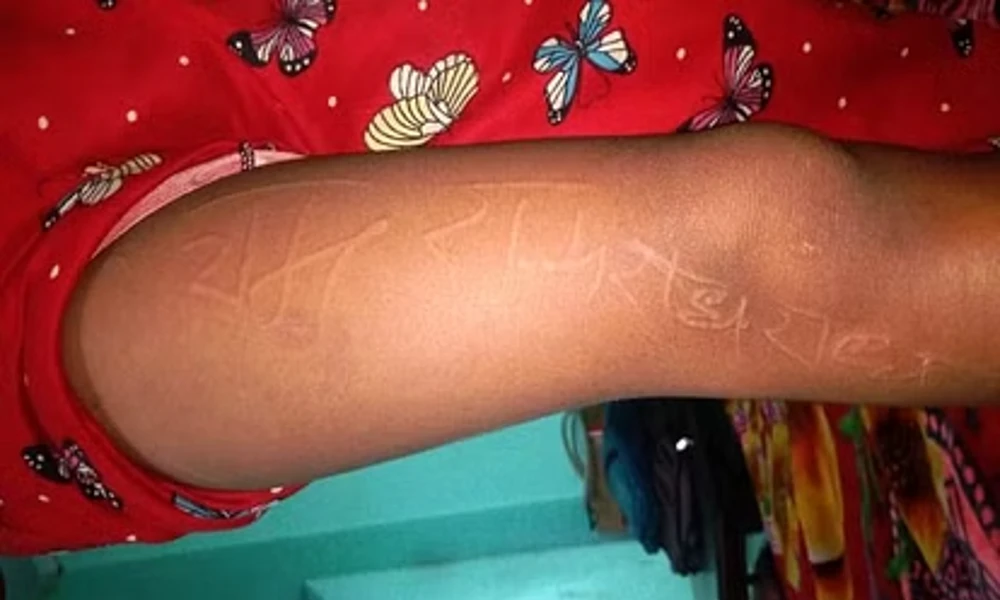 Radhe and Ram words on body of 8 year old girl in Uttar Pradesh