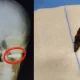 Bengaluru doctor pulls out bullet after hitting head