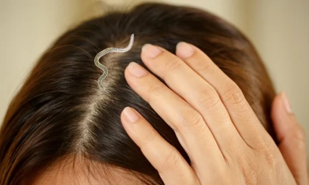 Larva found inside young womans scalp