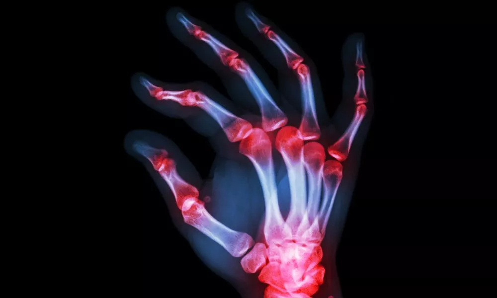 Rheumatoid Arthritis , Gouty Arthritis