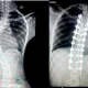Nigerian girl undergoes successful complex surgery on her spine