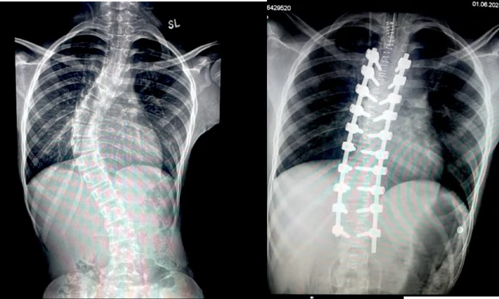 Nigerian girl undergoes successful complex surgery on her spine
