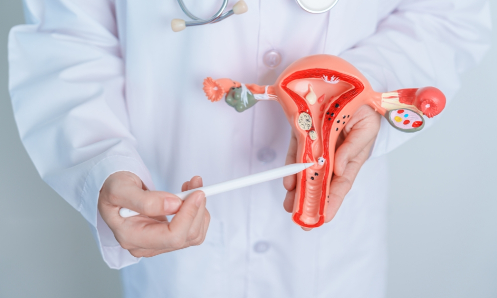 Doctor holding Uterus and Ovaries model. Ovarian and Cervical cancer,