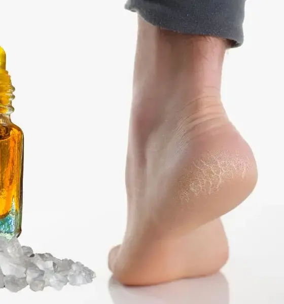 Home Remedy For Cracked Heels
