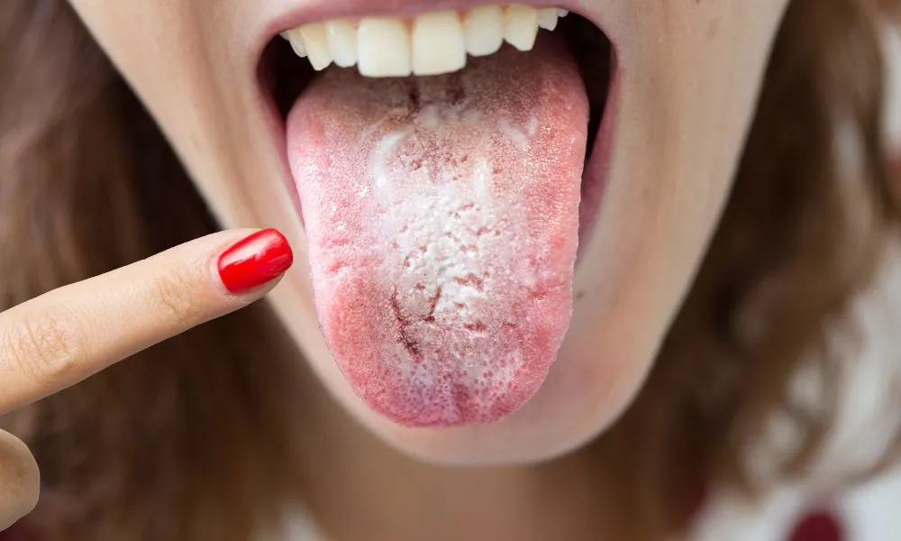 Woman with halitosis for candida albicans pointing her tongue