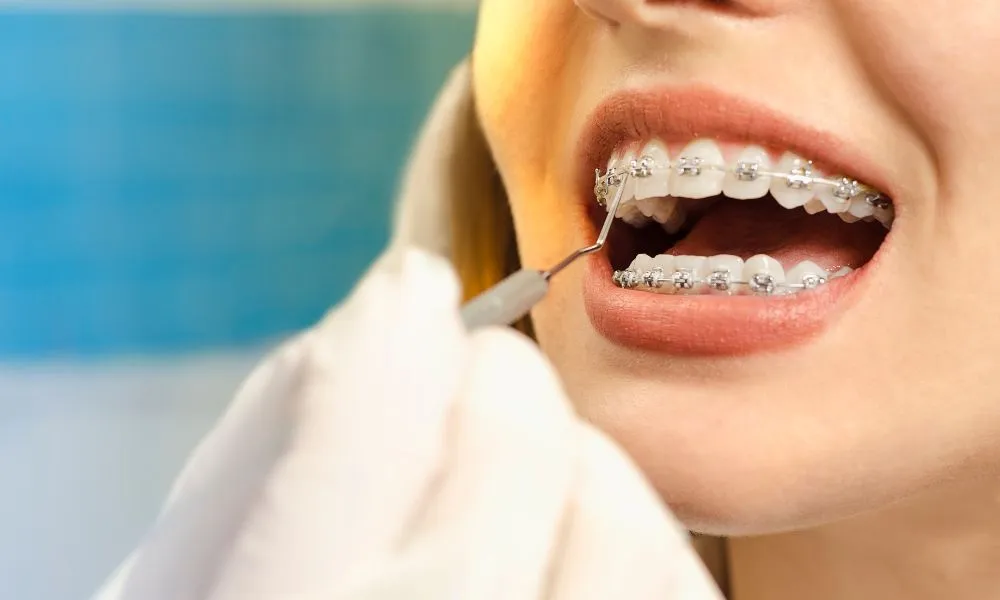 dental braces checkup
