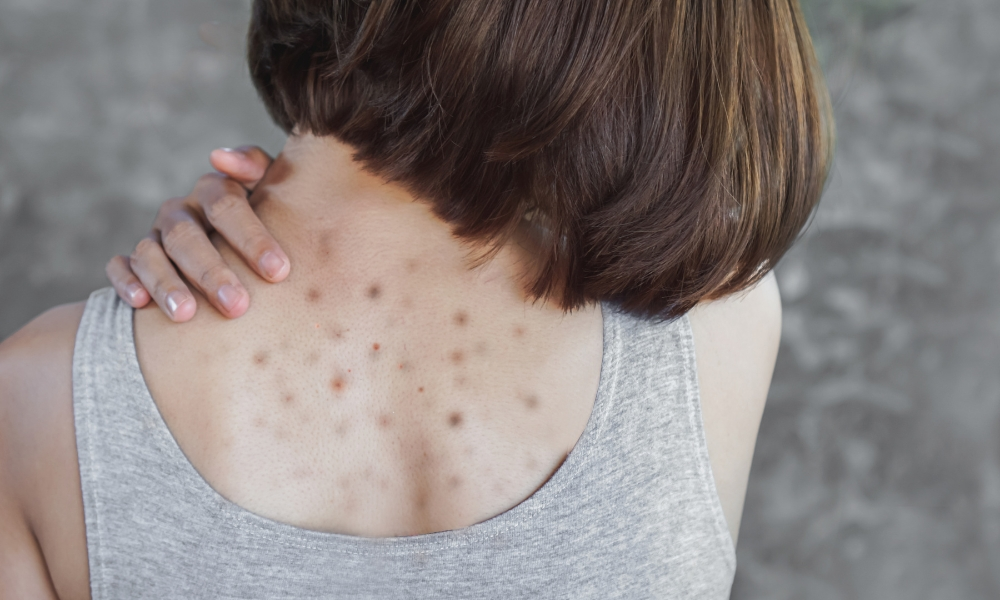 Asian woman having acne , dark and red spots on back, skin problem concept