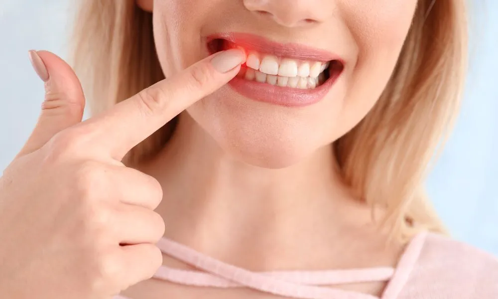 Irritation of the gums