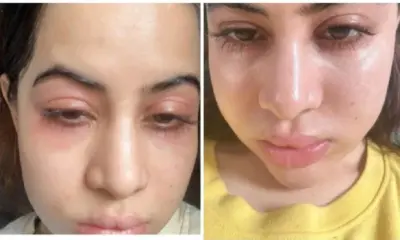 Urfi Javed shares photos of swollen face, accepts