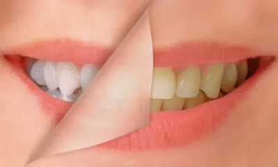 Whiten Your Yellow Teeth