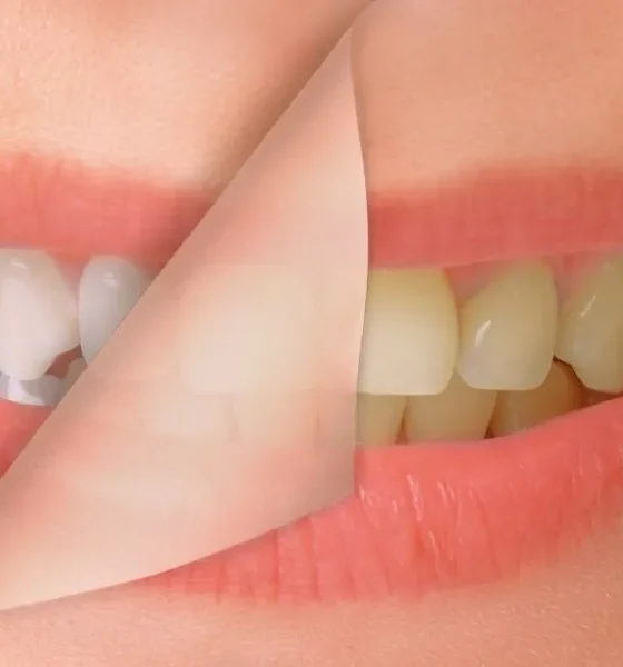 Whiten Your Yellow Teeth