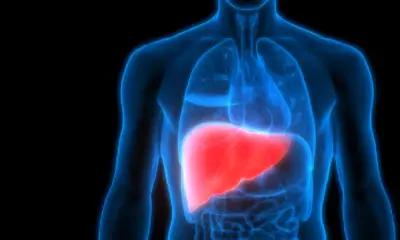 Fatty Liver What Causes