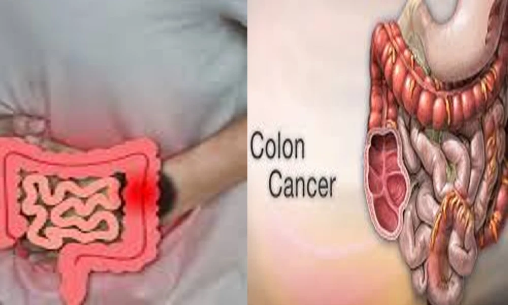 Colon cancer is on the rise‌ Those above 50 years of age are targeted