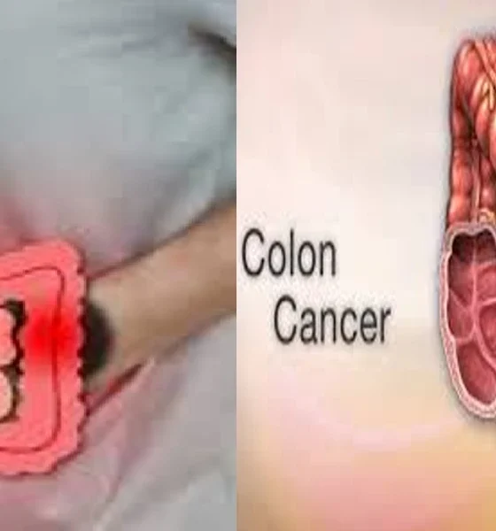 Colon cancer is on the rise‌ Those above 50 years of age are targeted