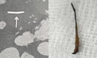 Doctors at Fortis Hospital remove fish bone from man's stomach for 5 years